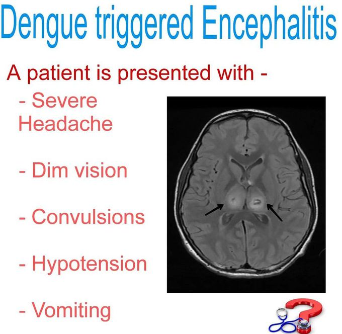 Dengue Triggered Encephalitis