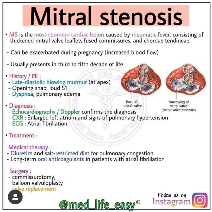 Mitral Stenosis - MEDizzy