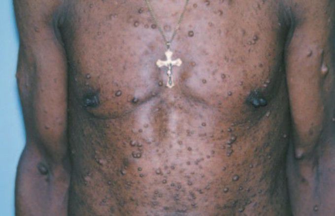 Neurofibromatosis type I