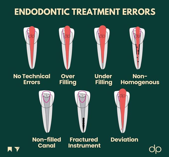 Endodontic Treatment Errors