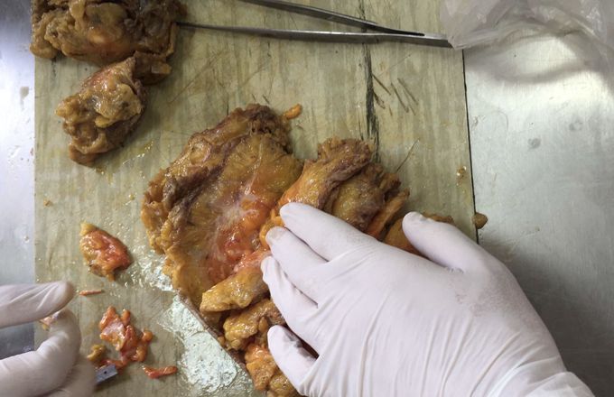 Carcinoma in situ breast