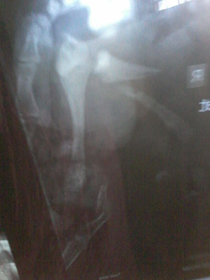 X-ray of a thigh of a 8 days old baby