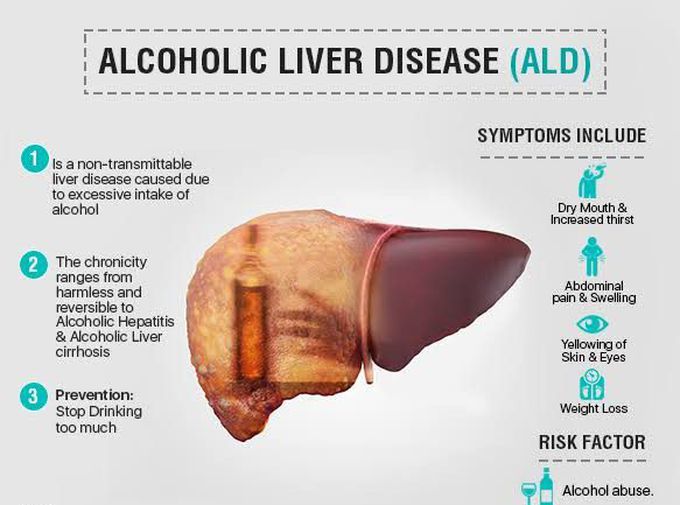 Alcohol Related Liver Disease