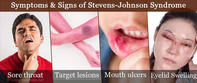 Steven Johnson syndrome symptoms