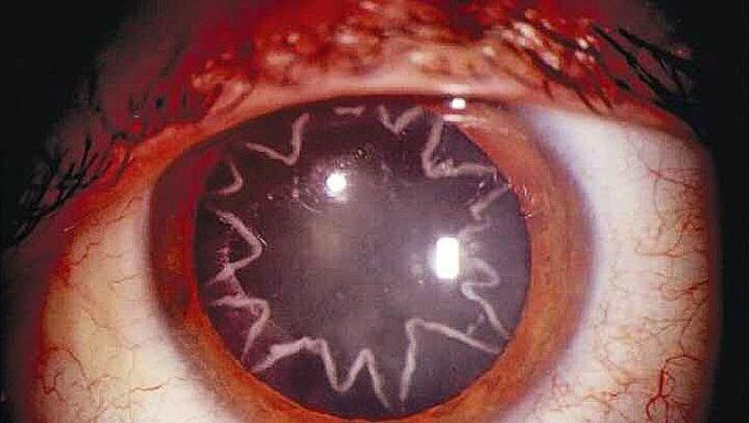 Star-shaped cataract after an electrical shock! 