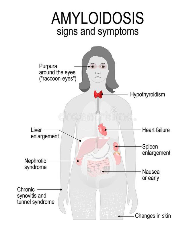 AMYLOIDOSIS ~~