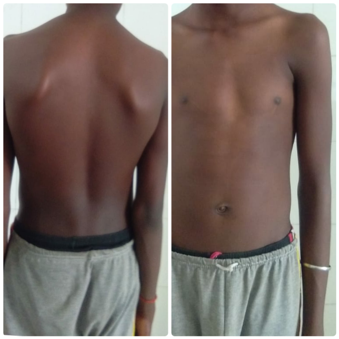 Winging of Scapula (congenital)
