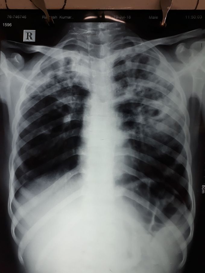 23 ur old male c/o cough with scanty sputum fever dyspnoea 2 month