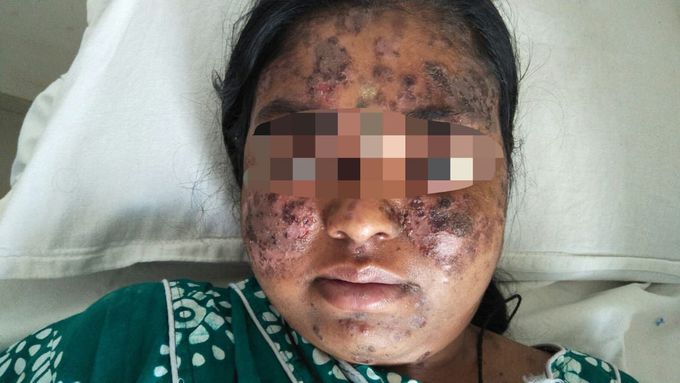 Pemphigus vulgaris