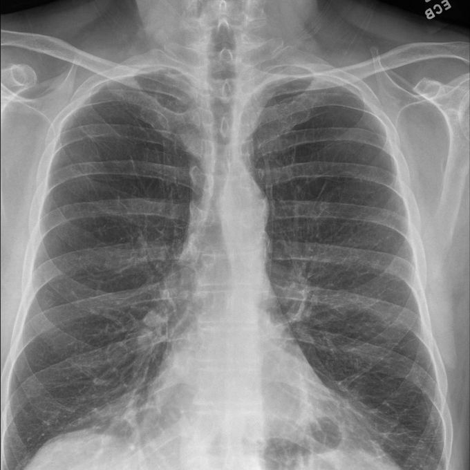 Sabre-sheath Trachea