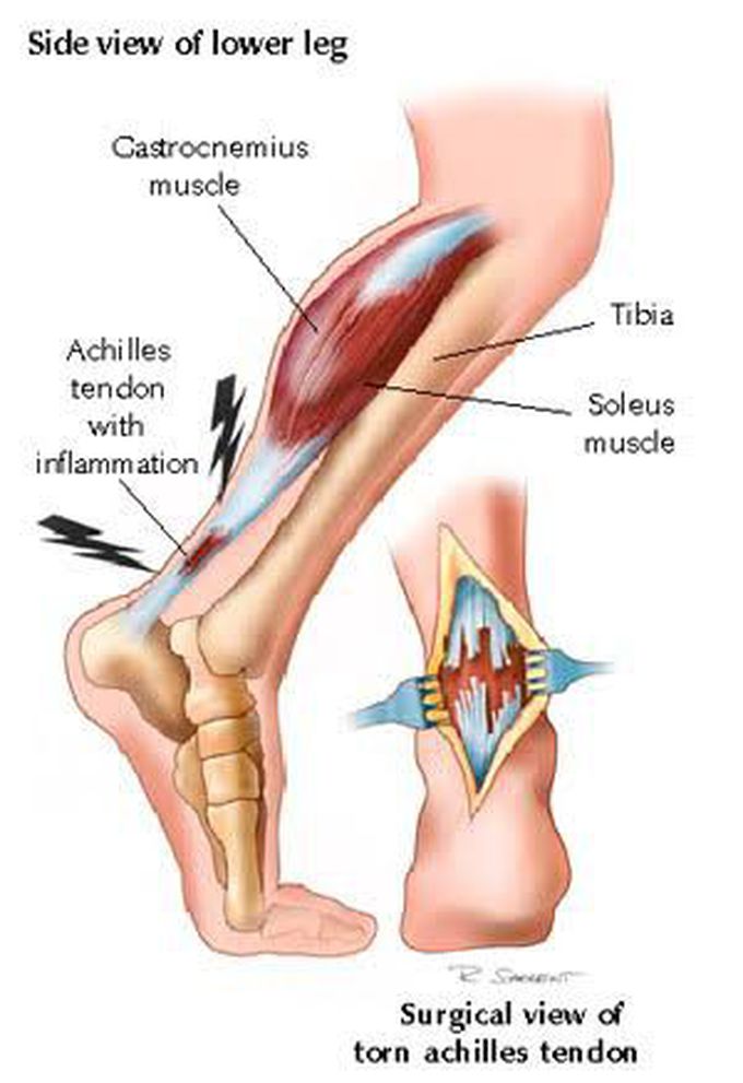 Achilles Tendon Rupture Medizzy 