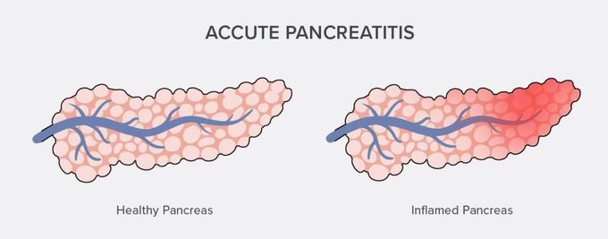 Acute pancreatitis