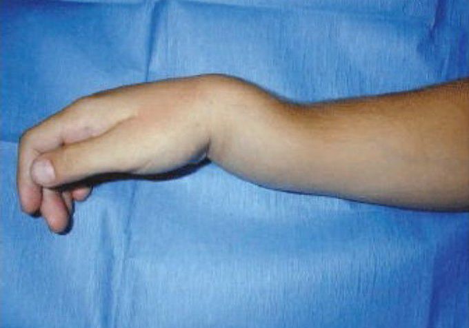 Colls fracture