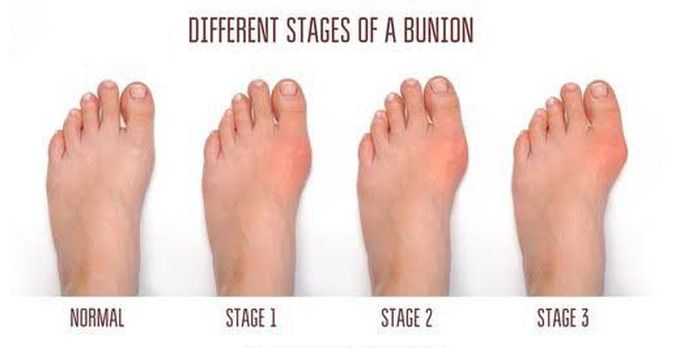Stages of bunion.