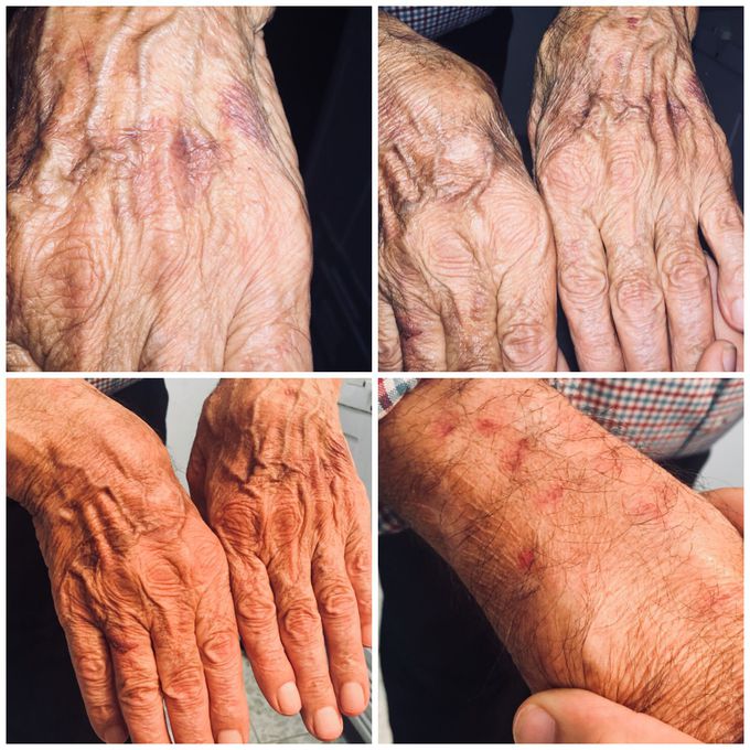 What is your diagnosis??                                                   A 65 years old male takes blood flow pills every week through two months cuz his blood flow is 75 and he started taking blood flow pills (half a pill) every day, he took Alphintern through two years and he stopped it . What is your diagnosis?