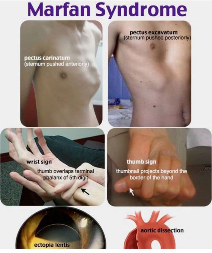 Marfan syndrom