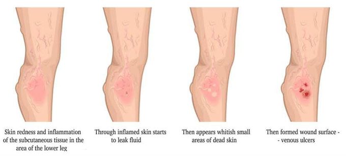 Venous leg ulcer