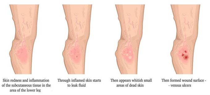 Venous leg ulcer