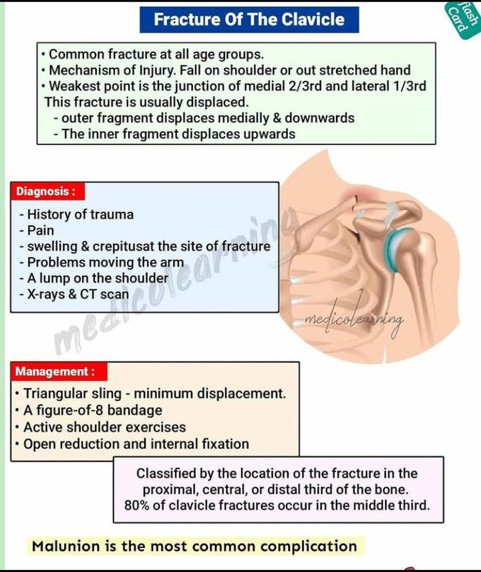 Fracture of the clavicle