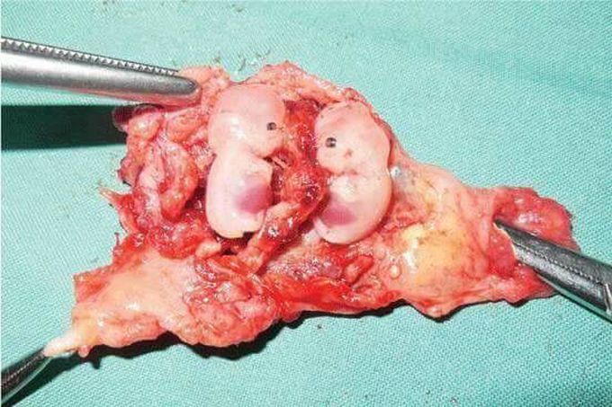 Ectopic Pregnancy