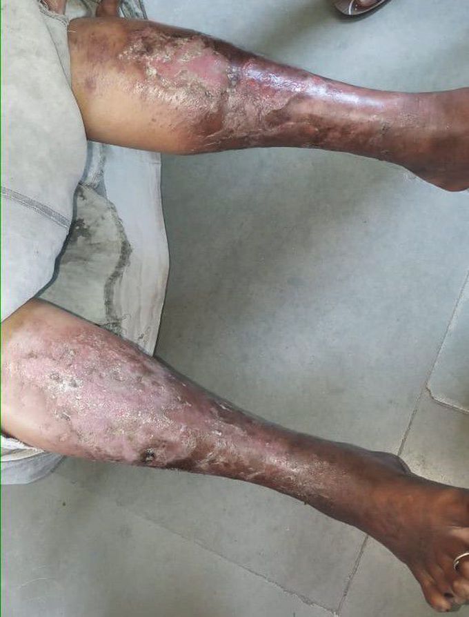 What is the best treatment?