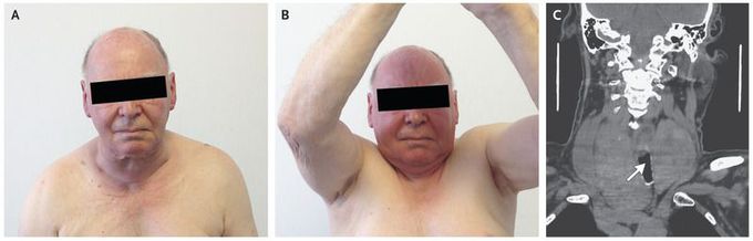 Pemberton’s Sign in a Patient with a Goiter