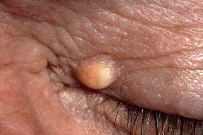 Epidermoid cyst