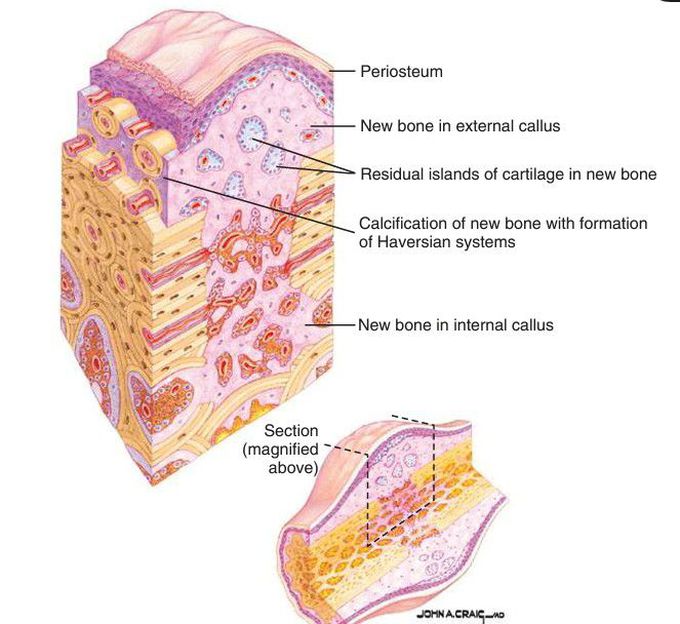 Remodeling stage of bone repair