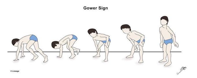 Gower sign