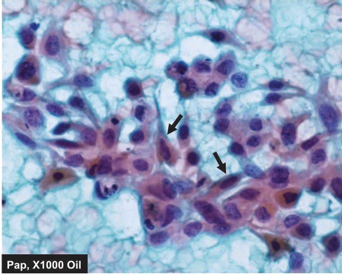 Invasive squamous cell carcinoma