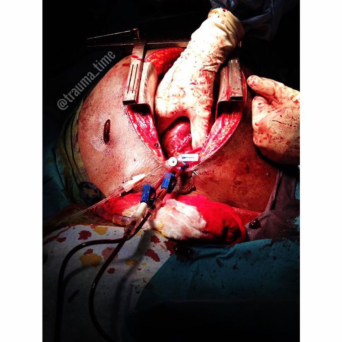 Emergency Thoracotomy