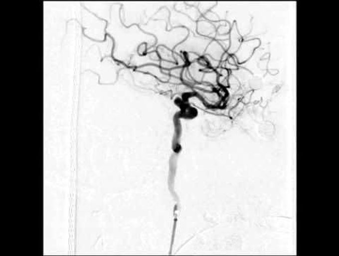 Endovascular treatment of a complex bilobed left superior hypophyseal ICA aneurysm