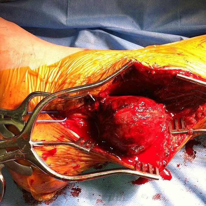 A huge blood clot formed in the leg