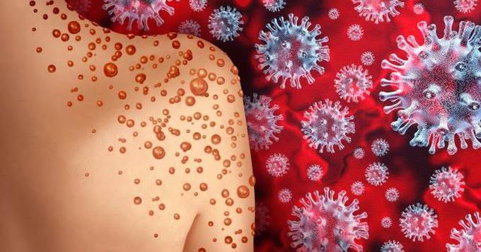 How is monkey pox diagnosed?