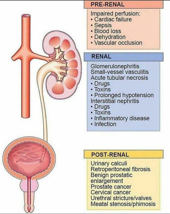 Causes of renal faliure