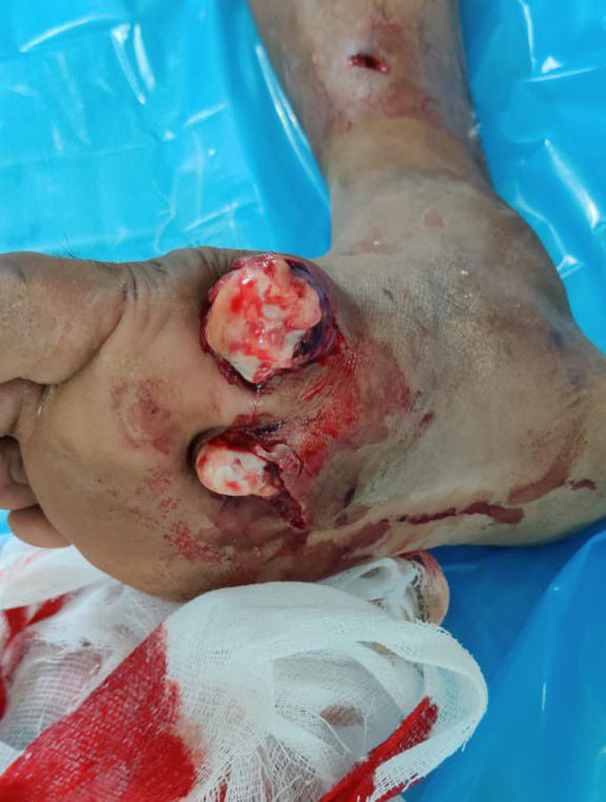 Road traffic accident