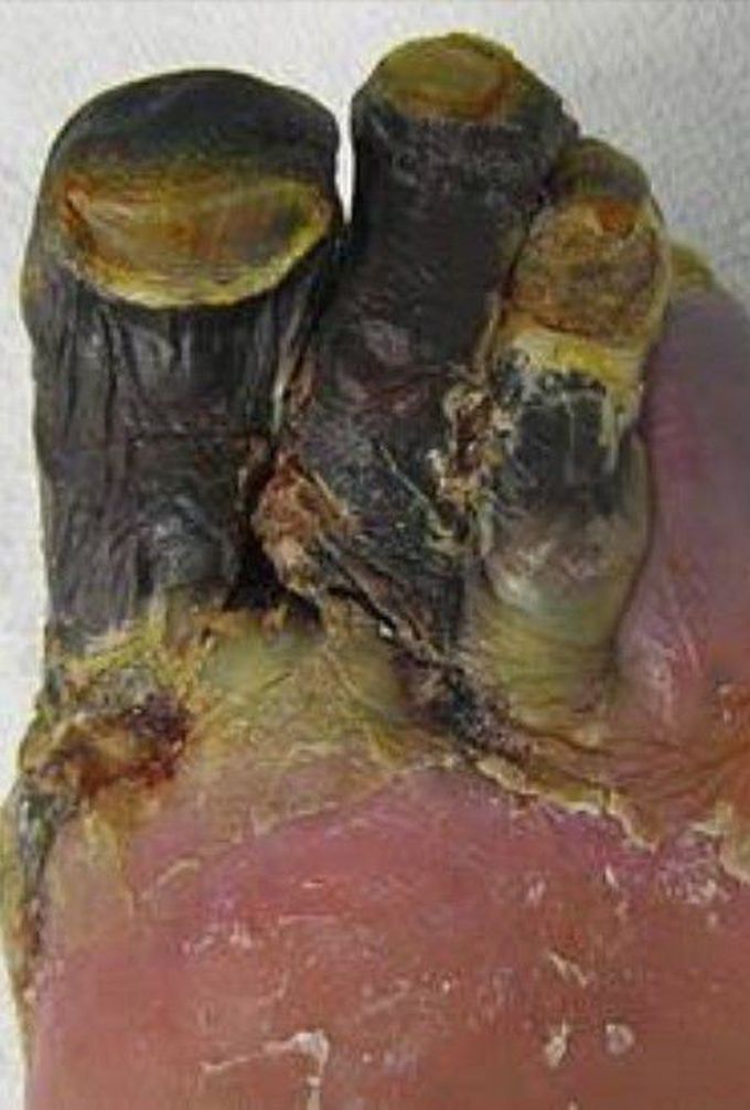 Dry gangrene.