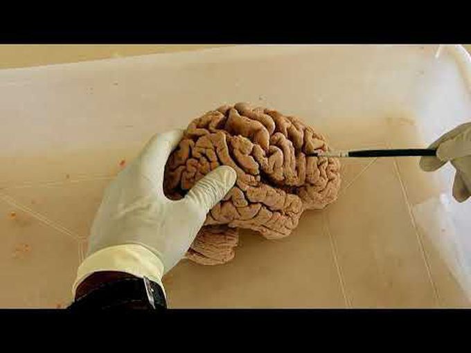 A Tutorial on Lobes, Gyri, and Sulci of Cerebral Hemisphere