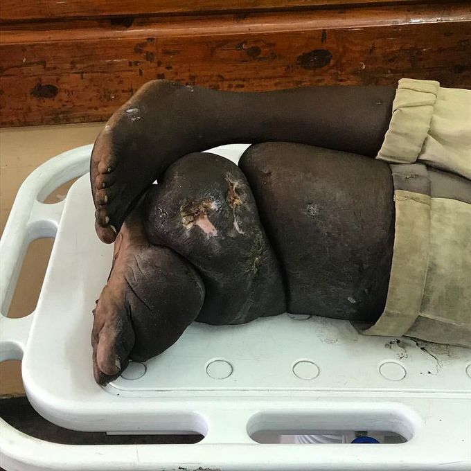 Elephantiasis in a young boy from Kenya!!