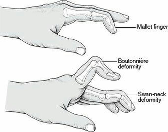 Deformities in the pic are characteristically seen in?