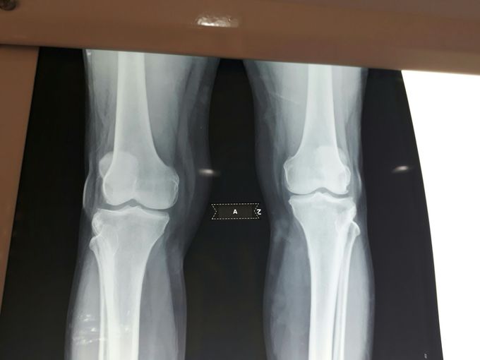 Osteoarthritis
