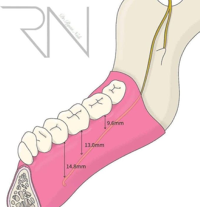 Lingual Nerve Proximity