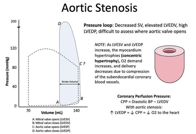 Aortic Stenosis