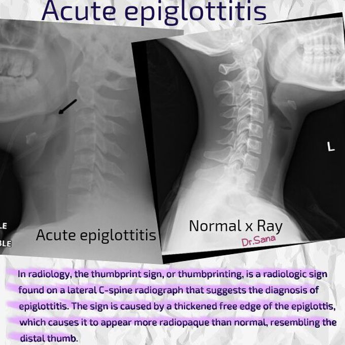 Epiglottitis Thumbprint Sign