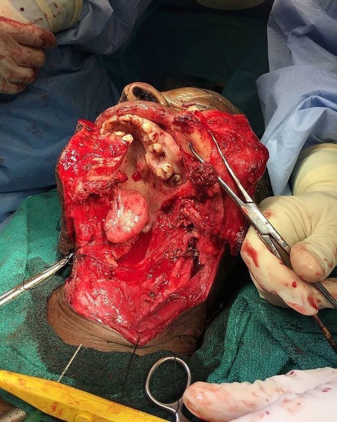 Oral cancer 
