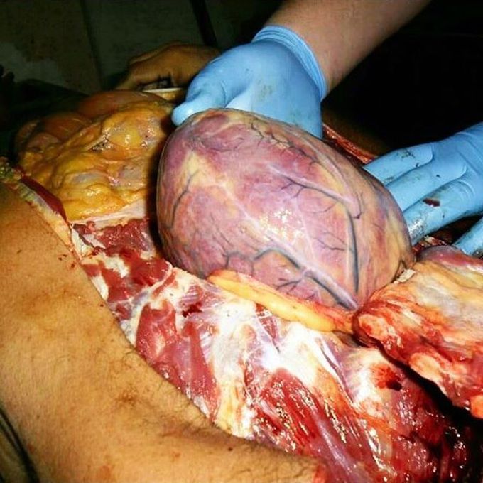 Massively enlarged heart