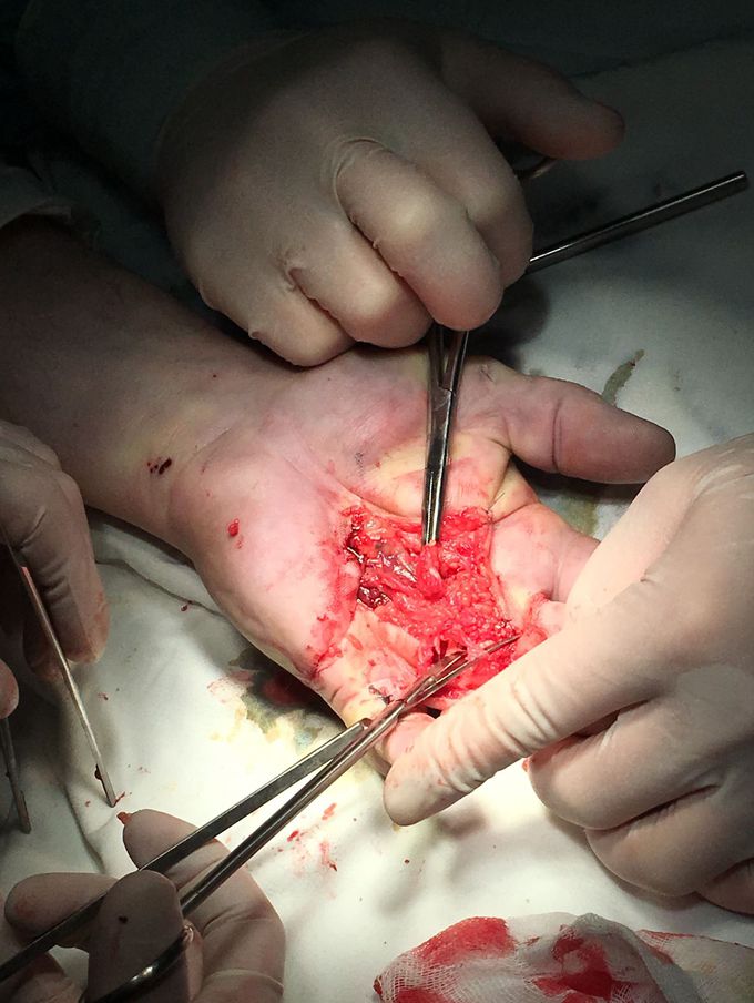 contractura de dupuytren