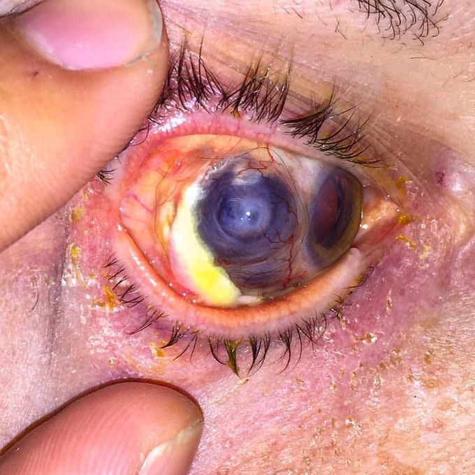 Case of scleromalacia perforans!