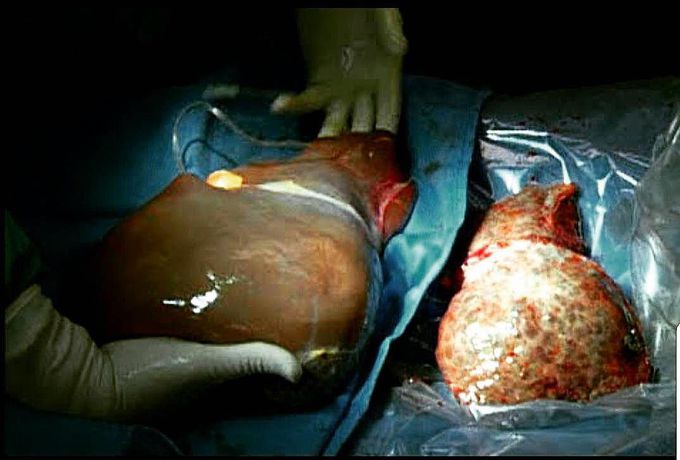 Patient with hepatitis C-related liver cirrhosis receives a liver transplant from a deceased donor!! 
