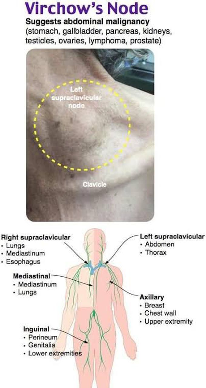 Virchow's Node